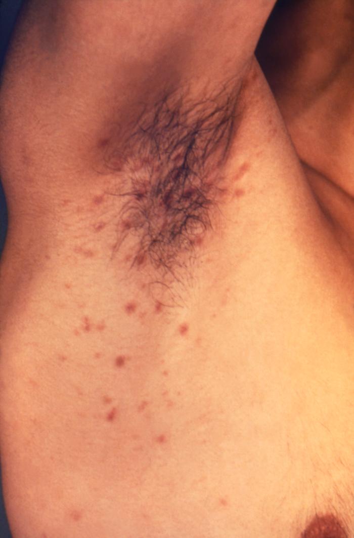 The right axillary region of this male patient exhibited a papular rash, which had been caused by an infestation of the human itch mite,Sarcoptes scabiei var. hominis, otherwise commonly known as scabies. The most common signs and symptoms of scabies are intense itching (pruritus), especially at night, and a pimple-like (papular) itchy rash. The itching and rash each may affect much of the body or be limited to common sites such as the wrist, elbow, armpit, webbing between the fingers, nipple, penis, waist, belt-line, and buttocks. The rash also can include tiny blisters (vesicles) and scales. Scratching the rash can cause skin sores; sometimes these sores become infected by bacteria. Adapted from CDC
