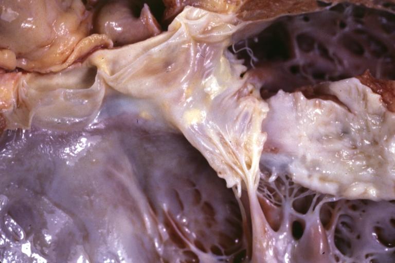 Dilated Cardiomyopathy: Gross natural color close-up view of heart surgically removed for a transplantation shows aortic valve and anterior leaflet of mitral valve with cholesterol deposits endocardium of left ventricle is diffusely thickened