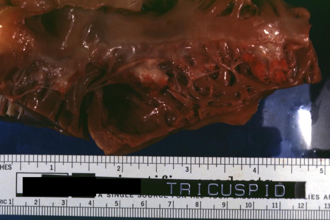 Thrombotic Non Bacterial Endocarditis: (Gross) Natural color and good example of tricuspid valve lesions