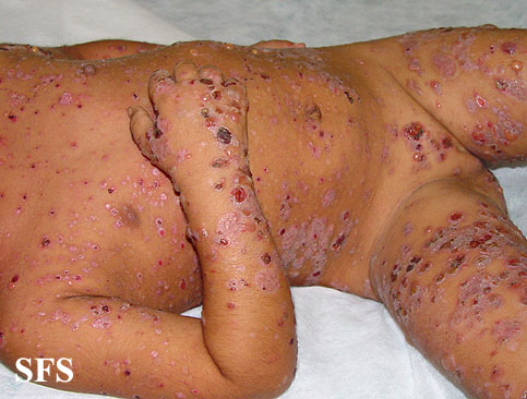 Childhood linear IgA disease. Adapted from Dermatology Atlas.[3]