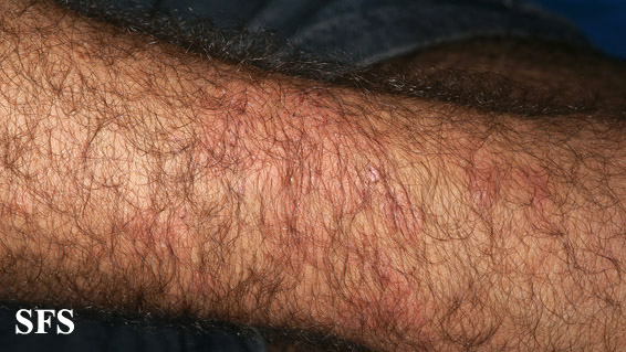 File:Dermatitis herpetiformis52.jpg