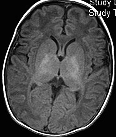 File:MRI cerebral palsy (13).gif