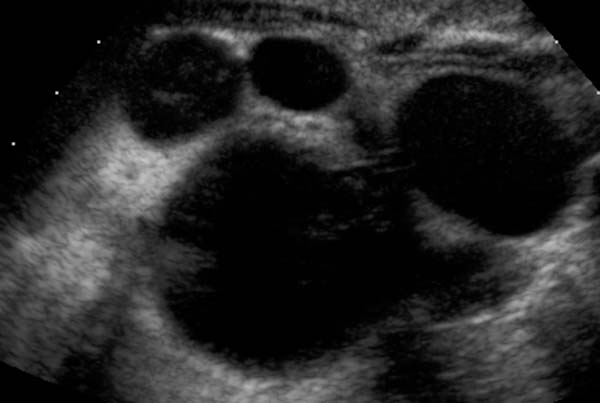 Ultrasonography: Multicystic dysplastic kidney