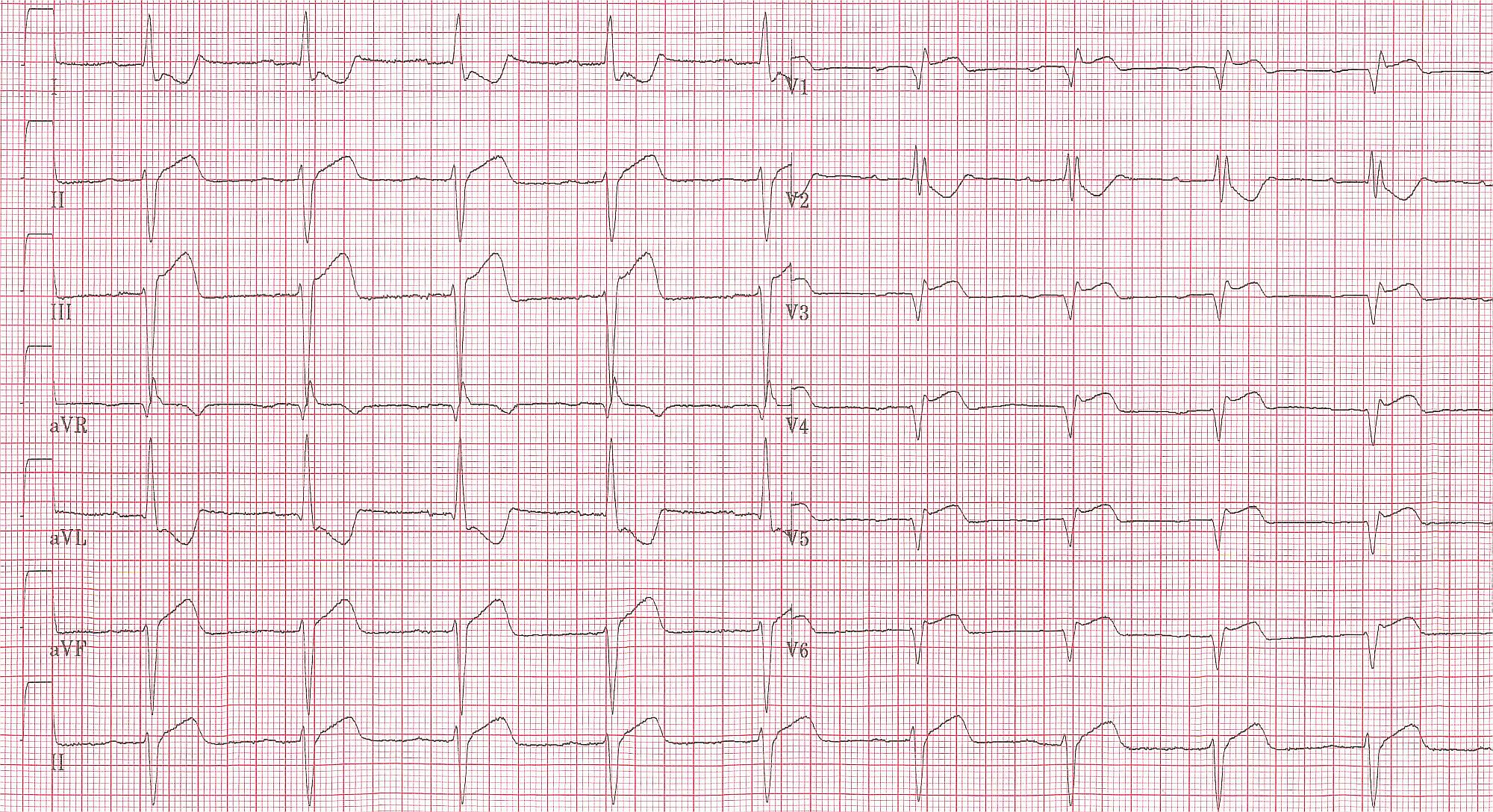 Lead V4R in the same patient with RBBB and inferior MI clearly shows ST elevation.