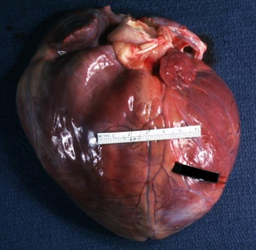 Dilated Cardiomyopathy: Gross natural color external view globular heart 500 gm 24yo female seven pregnancies