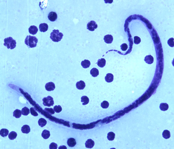 Microfilaria of B. timori in a thick blood smear from a patient from Indonesia, stained with Giemsa and captured at 500x oil magnification. Image from a specimen courtesy of Dr. Thomas C. Orihel, Tulane University, New Orleans, LA. Adapted from CDC