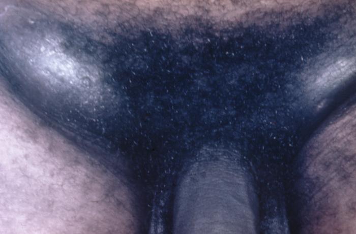 Chancroid infection has spread to the inguinal lymph nodes, which have enlarged forming buboes.