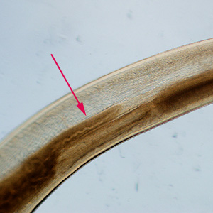 Close-up of the intestinal cecum in the same specimen seen in Figure 3. Adapted from CDC