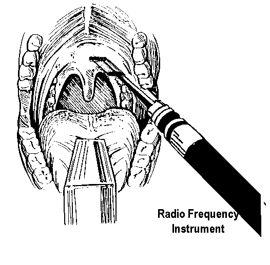 A special RF electrode is used to make two vertical cuts on either side of the uvula. These are joined by a horizontal cut and the uvula is removed. Occasionally, the edge of the soft palate is trimmed as well[3].