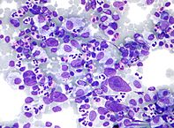 Micrograph showing Hodgkin lymphoma (Field stain)