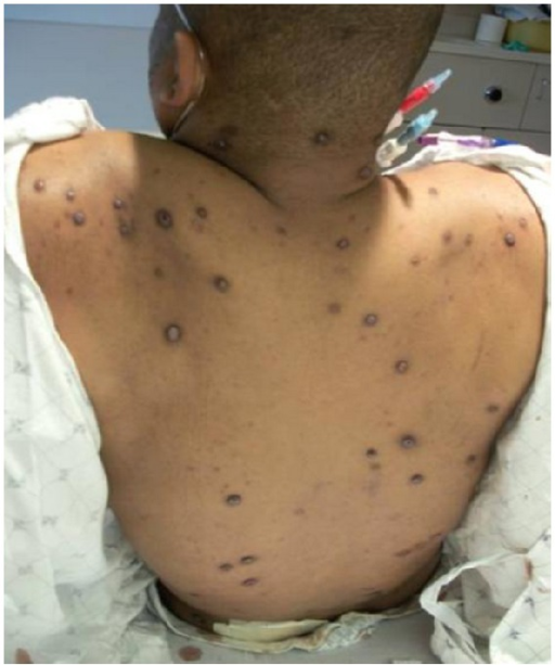 File:Hyperpigmented nodules with hemorrhagic crusting.png