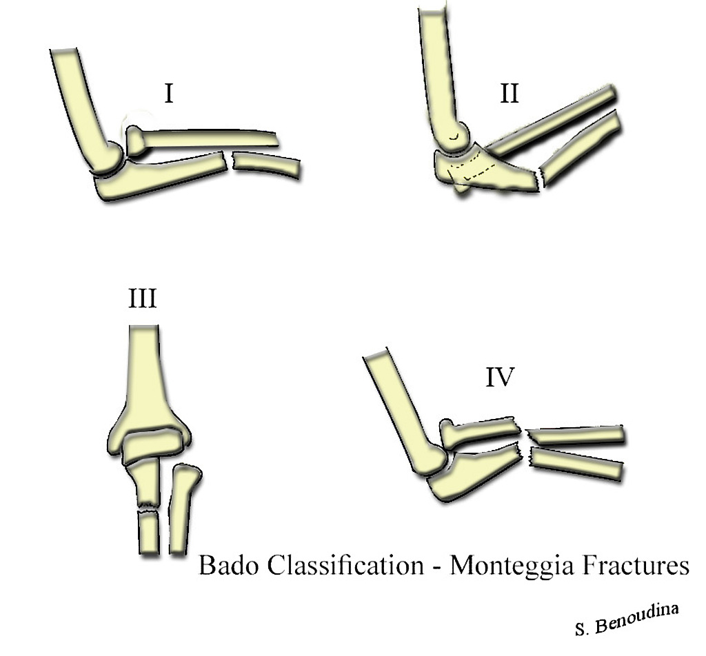 File:Monteggia-fractures-bado-classification.jpg