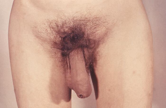 This patient presented with phimosis and inguinal lymphadenopathy due to primary syphilis. One of the symptoms of primary syphilis is the presence of lymphadenopathy, i.e. the swelling of the inguinal lymph nodes, either bilaterally or unilaterally, as well as the presence of a primary chancre. Adapted from CDC