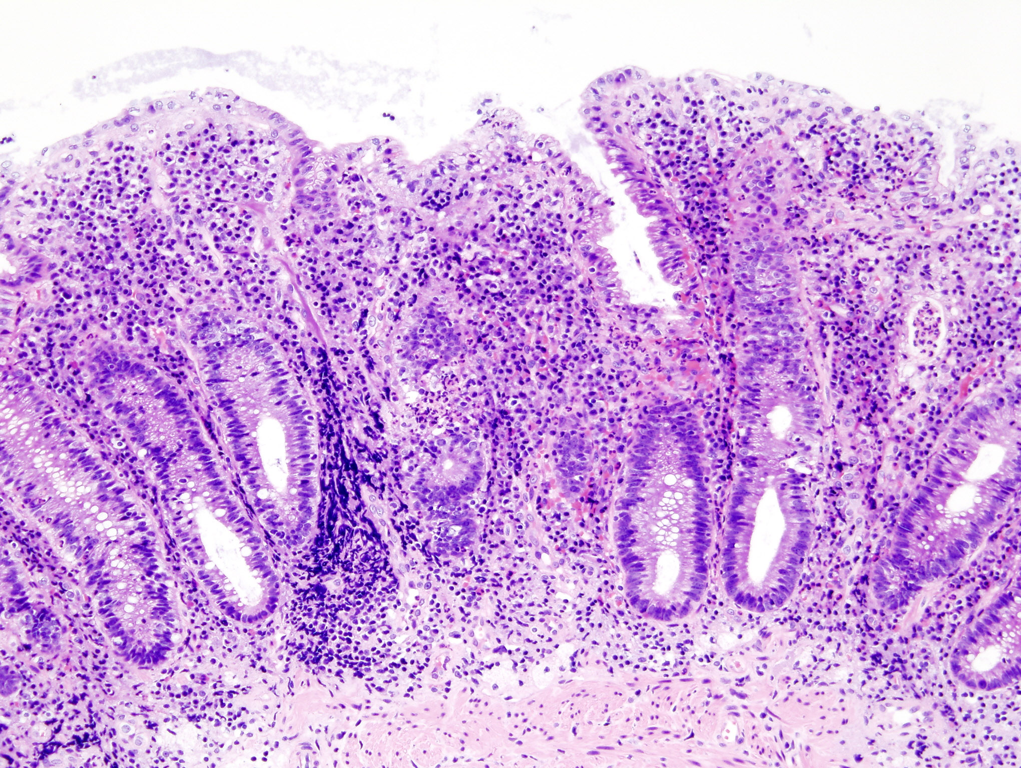 Ulcerative colitis. H&E stain showing marked lymphocytic infiltration (blue/purple) of the intestinal mucosa and distortion of the architecture of the crypts. [47]
