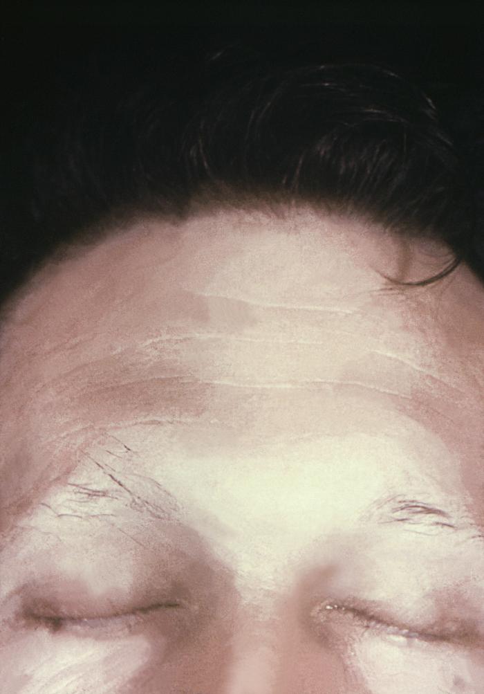 This image depicts the upper half of a patient’s face, who’d presented with what was described as syphilitic alopecia, which had caused thinning of the eyebrows, due to what was diagnosed as secondary syphilis. The secondary stage of syphilis is characterized by the manifestation of a skin rash and mucous membrane lesions. This stage typically starts with the development of a rash on one or more areas of the body. The rash usually does not cause itching. Rashes associated with secondary syphilis can appear as the chancre is healing or several weeks after the chancre has healed. The characteristic rash of secondary syphilis may appear as rough, red, or reddish brown spots both on the palms of the hands and the bottoms of the feet. However, rashes with a different appearance may occur on other parts of the body, sometimes resembling rashes caused by other diseases. Sometimes rashes associated with secondary syphilis are so faint that they are not noticed. In addition to rashes, symptoms of secondary syphilis may include fever, swollen lymph glands, sore throat, patchy hair loss, headaches, weight loss, muscle aches, and fatigue. The signs and symptoms of secondary syphilis will resolve with or without treatment, but without treatment, the infection will progress to the latent and possibly late stages of disease. Adapted from CDC