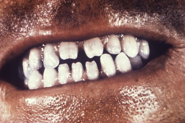 This image depicts the dentition of a congenital syphilis patient, who due to this disease, went on to develop what are known as Hutchinson’s teeth, in which case the teeth are widely spaced, and the bite surfaces of the incisors are notched. Congenital syphilis, is a condition caused by infection in utero with Treponema pallidum. A wide spectrum of severity exists, and only severe cases are clinically apparent at birth. An infant or child (aged less than 2 years) may have signs such as hepatosplenomegaly, rash, condyloma lata, snuffles, jaundice (nonviral hepatitis), pseudoparalysis, anemia, or edema (nephrotic syndrome and/or malnutrition). An older child may have stigmata (e.g., interstitial keratitis, nerve deafness, anterior bowing of shins, frontal bossing, mulberry molars, Hutchinson teeth, saddle nose, rhagades, or Clutton joints). Adapted from CDC