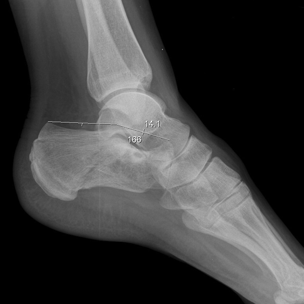 Calcaneal fracture with a decreased Bohler angle to 14 degrees.