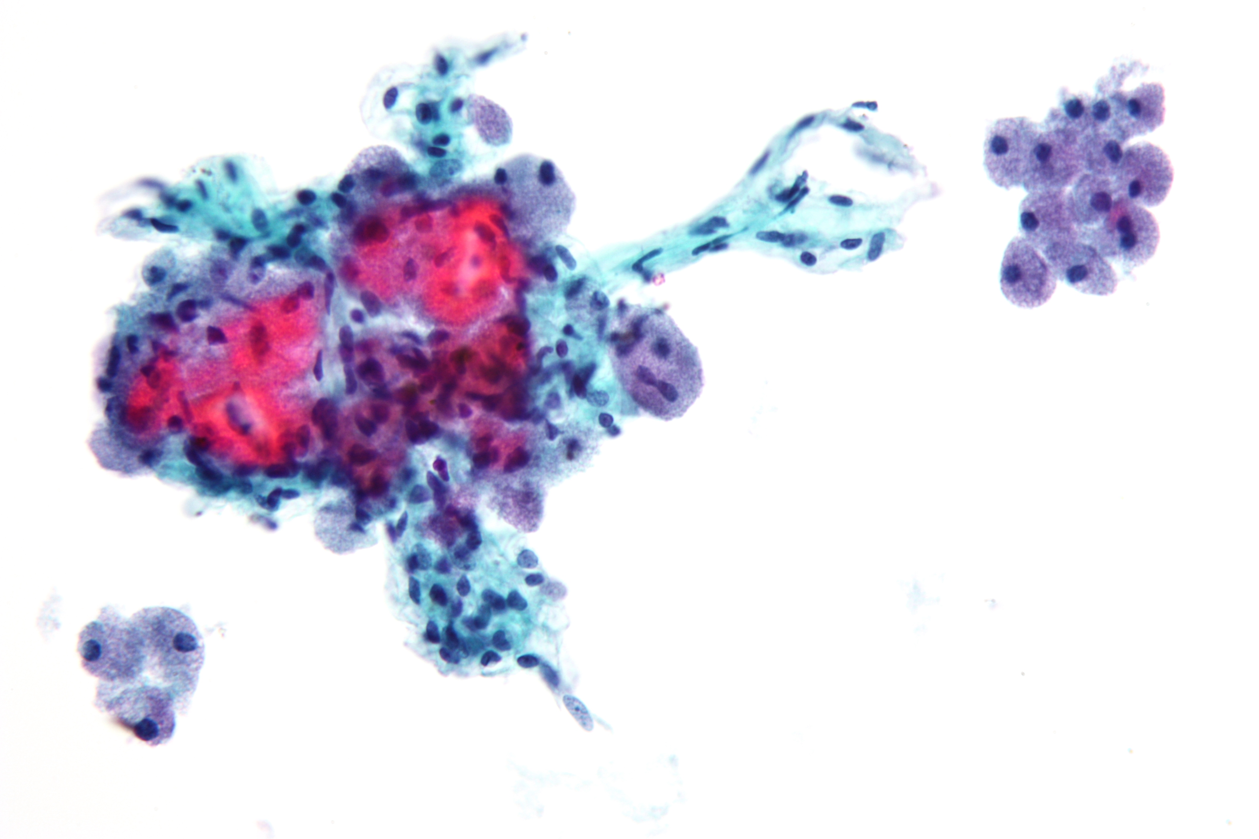 File:Hurthle cell neoplasm.jpg