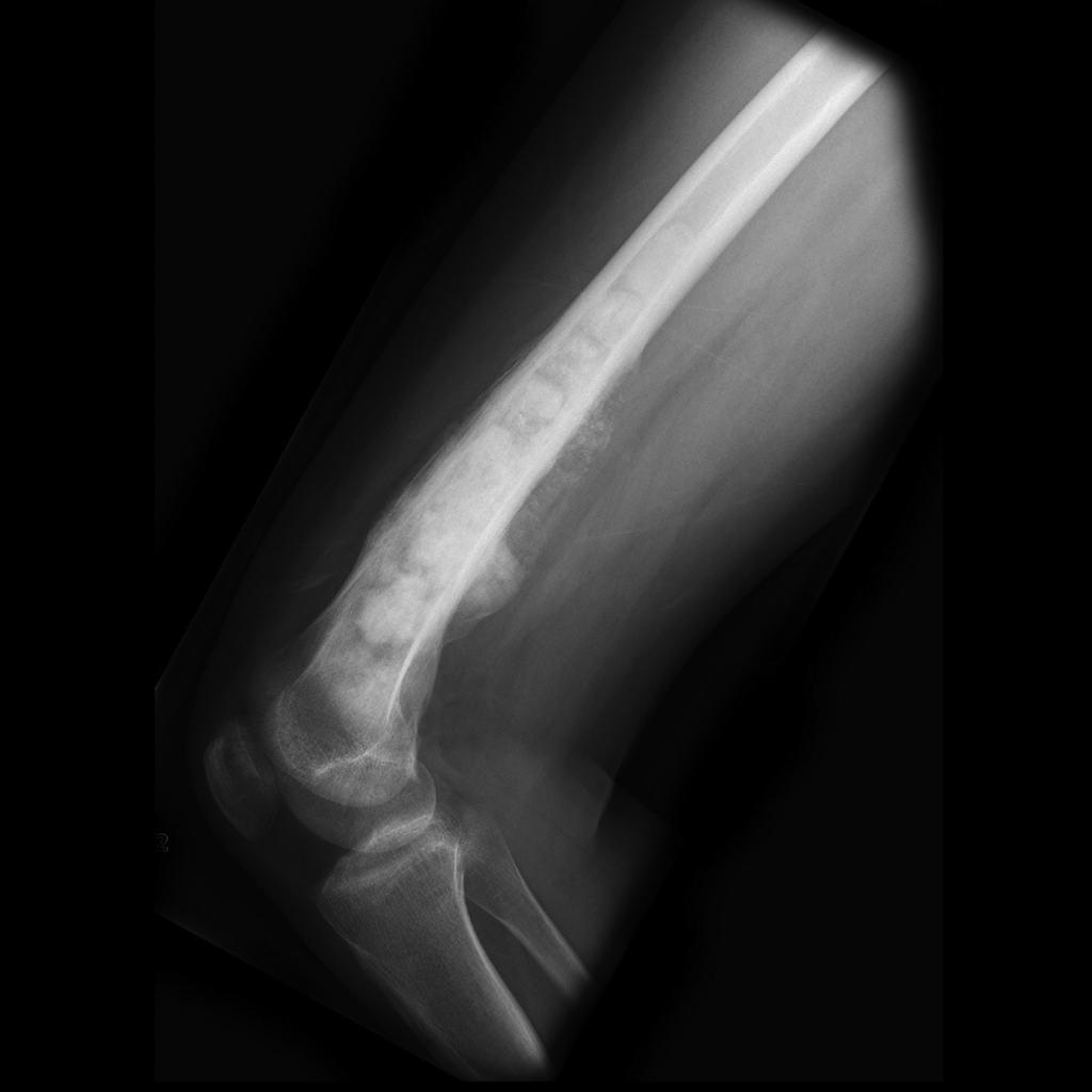 File:Osteosarcoma-of-the-distal-femur (1).jpg
