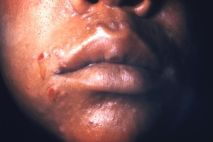 This patient presented with secondary syphilitic lesions on the face. The second stage starts when one or more areas of the skin break into a rash that appears as rough, red or reddish brown spots both on the palms of the hands and on the bottoms of the feet. Even without treatment, rashes clear up on their own. Adapted from CDC