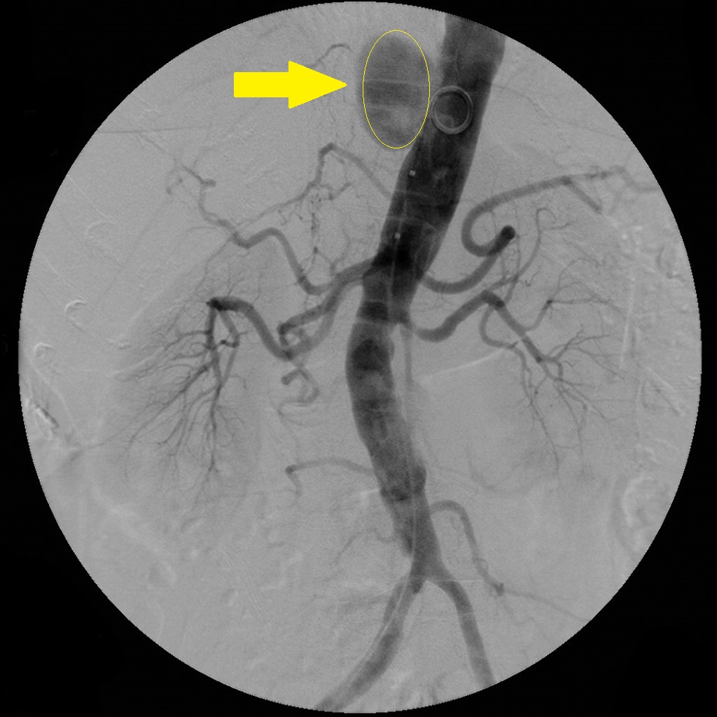 File:Penetrating-aortic-atherosclerotic-ulcer-with-false-aneurysm (1).jpg