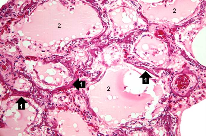 This photomicrograph demonstrates pulmonary alveoli with extensive calcium depositions (1) in the septa and protein accumulations (2) in the alveoli.