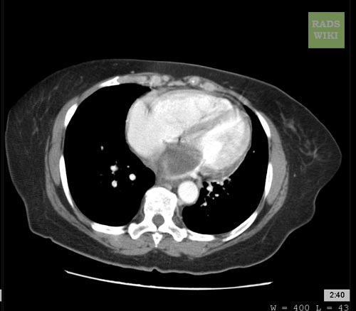 CT demonstrate a cardiac myxoma in the left atrium Image courtesy of RadsWiki and copylefted