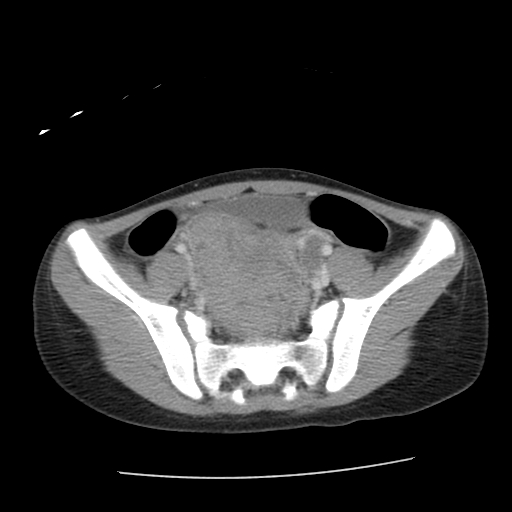 8 y/o female with right lower quadrant pain patient#2