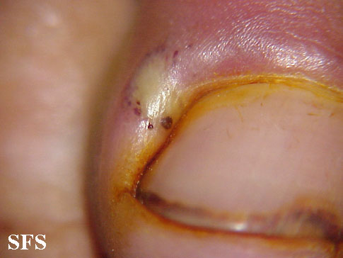 Tungiasis. Adapted from Dermatology Atlas.[1]