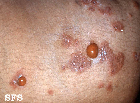 File:Dermatitis herpetiformis07.jpg