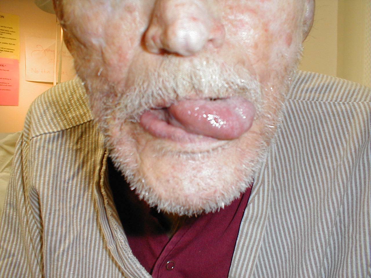 Left CN 12 Dysfunction: Stroke has resulted in L CN 12 Palsy. Tongue therefore deviates to the left.