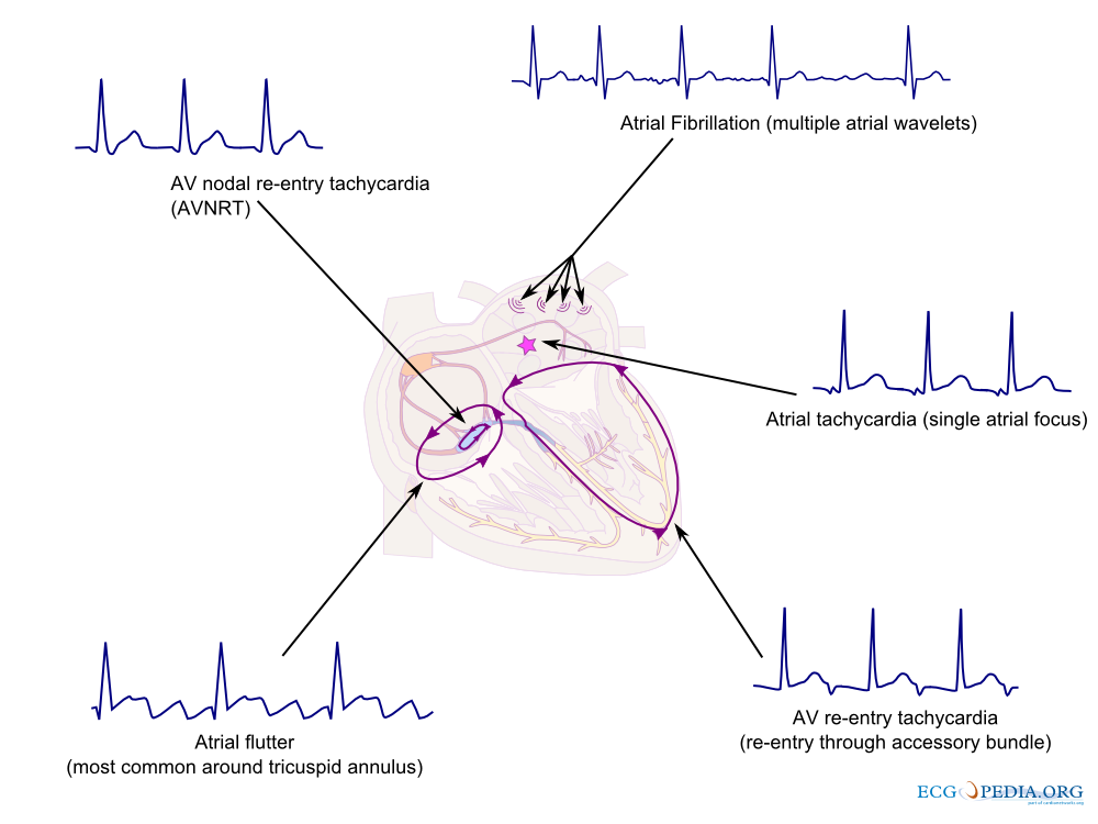 An overview of common supraventricular arrhythmias and their origin