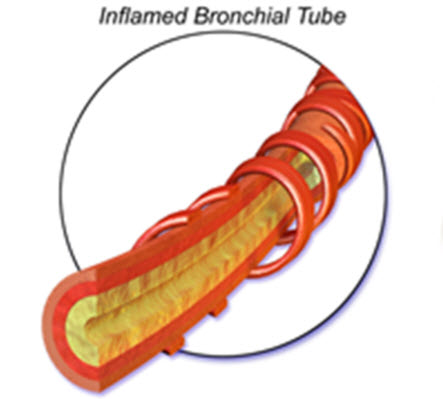 Inflamed Bronchi