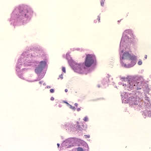 Balantidium coli trophozoites in colon tissue stained with hematoxylin and eosin (H&E) at 400x magnification. Adapted from CDC