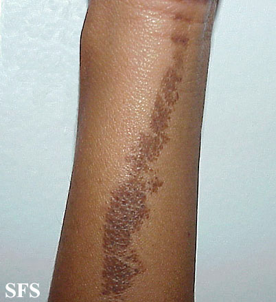 Naevus comedonicus. Adapted from Dermatology Atlas.[4]