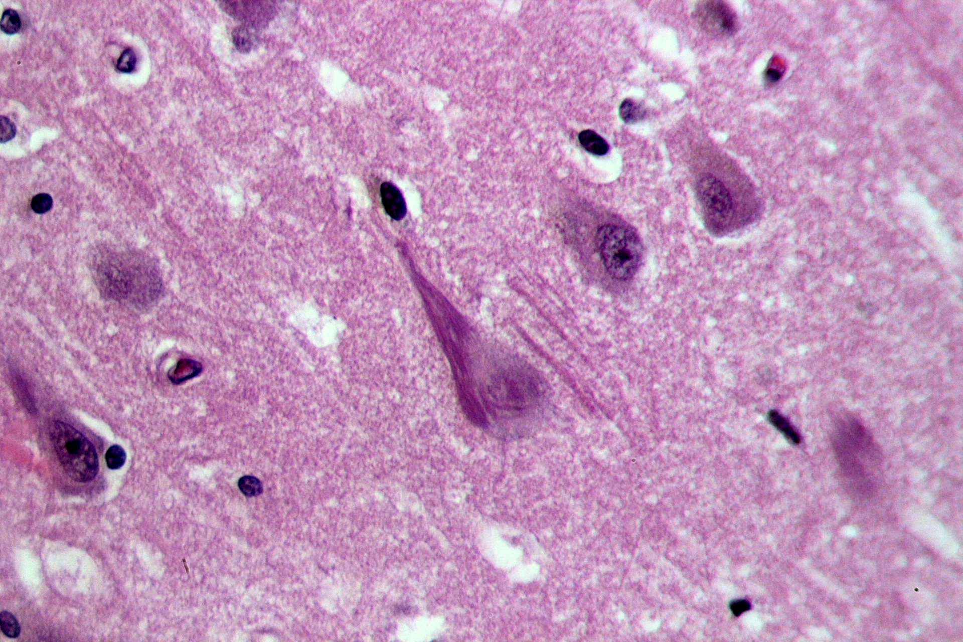 File:Neurofibrillary tangles in the Hippocampus HE 3.JPG