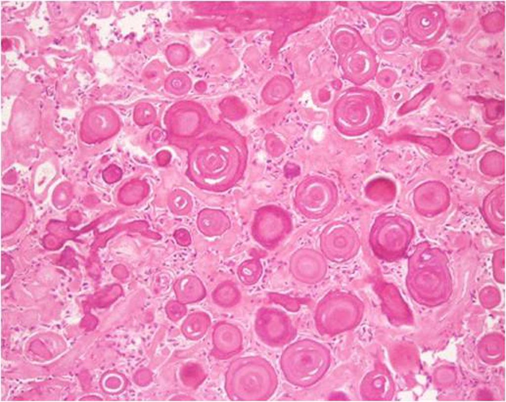 File:Psammomatous meningioma histopathology.jpg