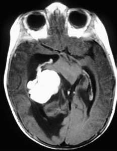 Choroid plexus papilloma: T2 weighted axial MRI shows intense surrounding vasogenic edema. Choroid plexus papilloma (CPP) are the most common tumor arising in the trigone of the lateral ventricle in children. They represent 2-5% of all primary brain tumors in children, with almost 90% occurring in children less than five years old. In children, they usually arise in the trigone of the lateral ventricle. In adults they commonly arise in the fourth ventricle. Less than 10% occur in the third ventricle or elsewhere. Patients usually present with hydrocephalus.
