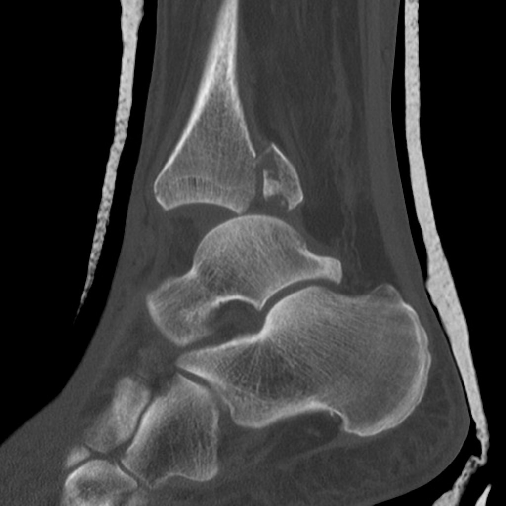 Sagittal bone window Displaced distal fibular fracture with mild posterior angulation/ displacement. Comminuted and moderately displaced posterior malleolus fracture with a large articular surface