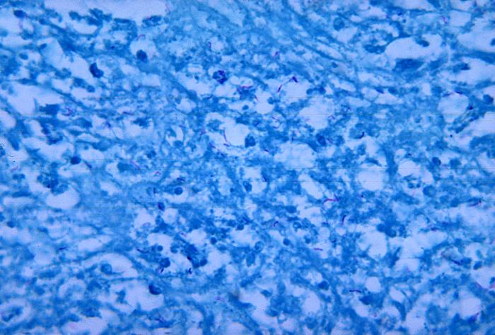 Histopathologic changes due to nocardiosis of a mesenteric lymph node using a FFN stain. From Public Health Image Library (PHIL). [1]