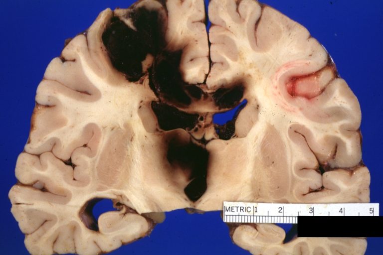 Brain: Lupus Erythematosus Libman Sacks Embolism: Gross fixed tissue large hemorrhagic infarcts due to embolism 19yo female with known lupus and history of TIAs