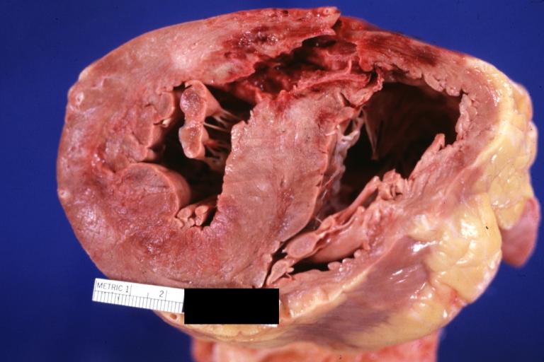 Heart, Acute MI, Ventricular septum rupture at posterior wall.