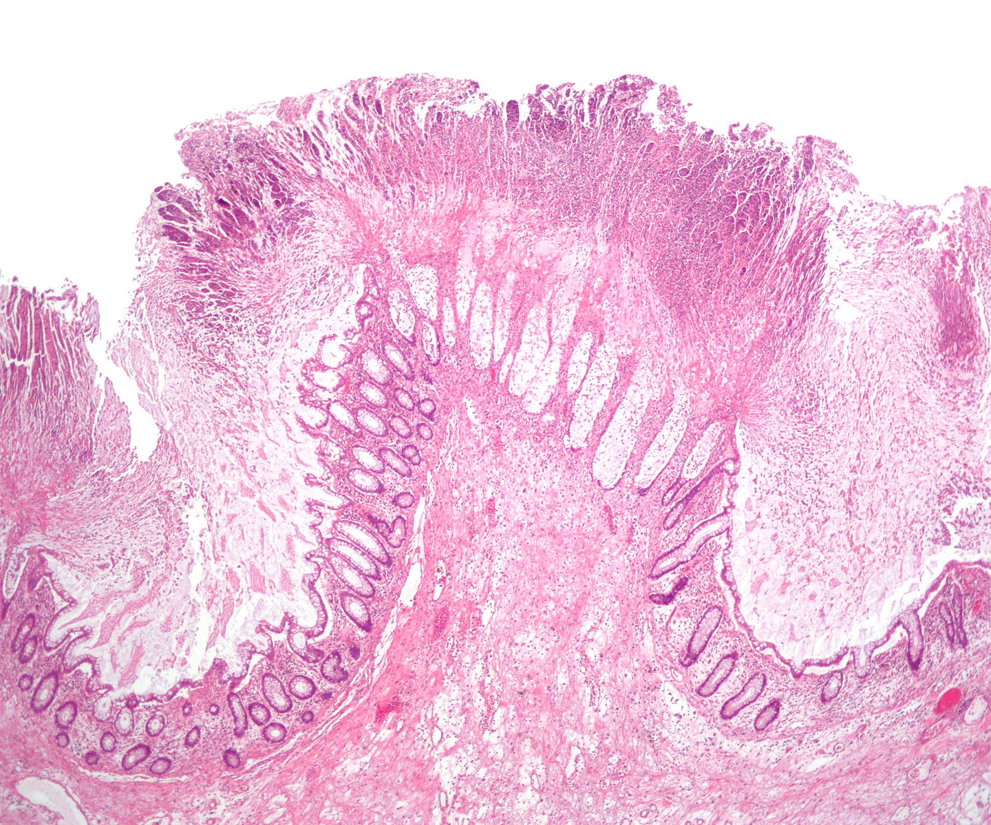 Pseudomembranous colitis. H& E staining showing pseudomembranes in Clostridium colitis [48]