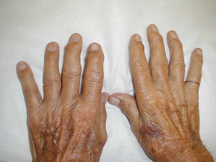 Heberden's nodes: Bony prominences at distal interphalangeal joints, seen in some patients with osteoarthritis.