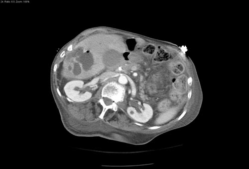CT image demonstrates a large abscess in the right hepatic lobe