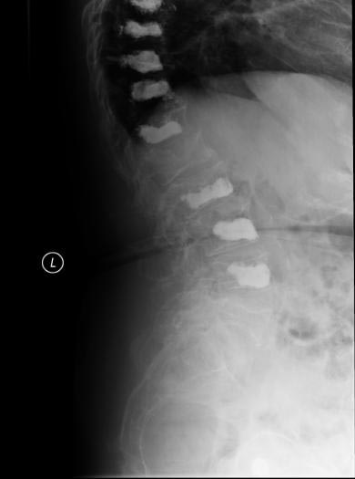 X ray spine showing increased space between 2 vertebrae suggestive of possible malignancy.
