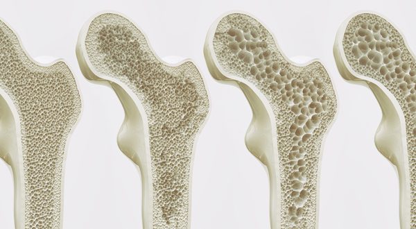 File:Osteoarthritis screening.jpg