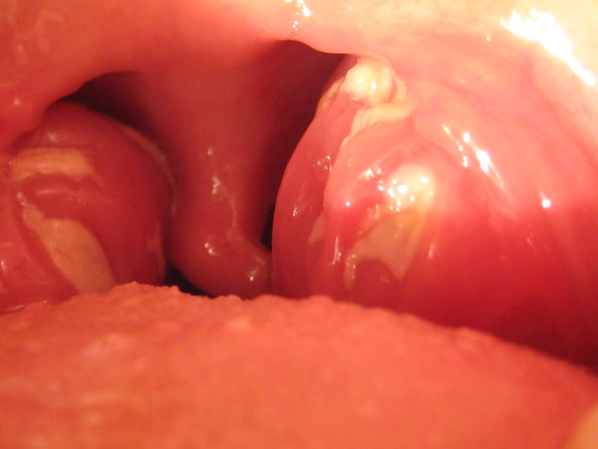 File:1200px-Mono tonsils.JPG