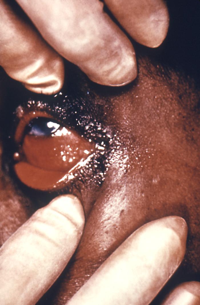 A highly contagious infection, gonococcal ophthalmia is due the pathogenic bacteria Neisseria gonorrhoeae. This case involved an adult patient with a systemically disseminated gonococcal infection, but neonates are in danger of acquiring this ophthalmic infection at the time of their delivery when the mother is infected with N. gonorrhoeae bacteria. Adapted from CDC
