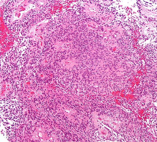 Micrograph of an ependymoma